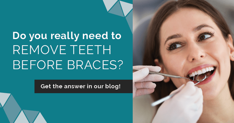 Do you really need to remove teeth before braces? Get the answer in our blog!