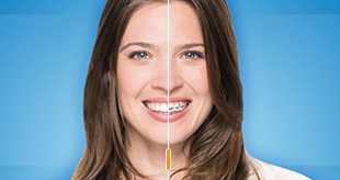 Invisalign, braces, or both? How to decide.