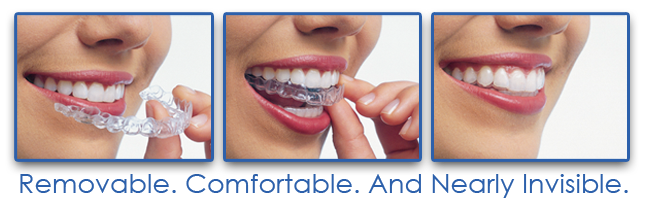 invisalign-what-are-the-latest-advancements-in-teeth-strightening