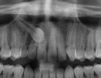Impacted upper canines and self-correction