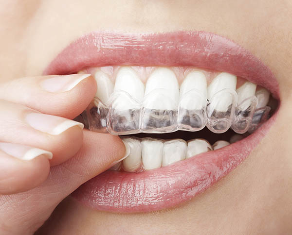 Woman wearing the invisalign aligner and showing off how it looks in her mouth