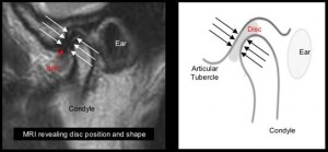 MRI image of normal TMJ