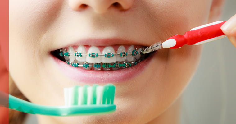 Patient with braces smiling with an ortho brush and toothbrush next to mouth