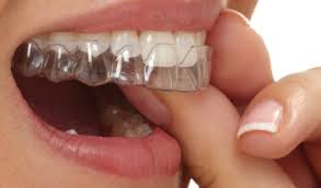 clear aligners before cosmetic bonding