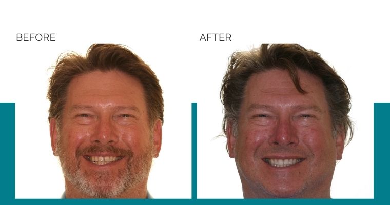 Rob's Invisalign before and after results.