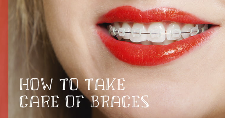 How to take care of braces