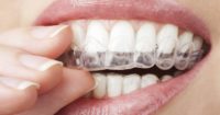 A close-up of a person holding a clear aligner to their teeth